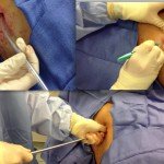 Chest Tube Placement