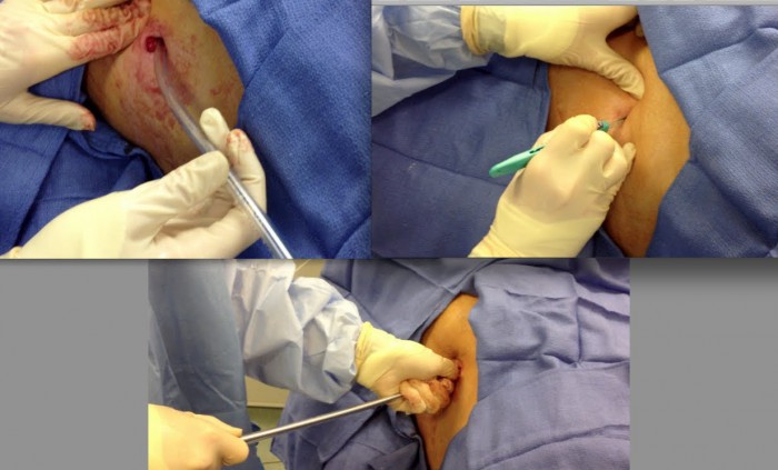 Chest Tube Placement